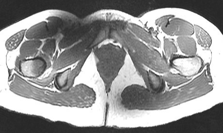Figure 3 for case Calcar stress fracture ( RID4695 )